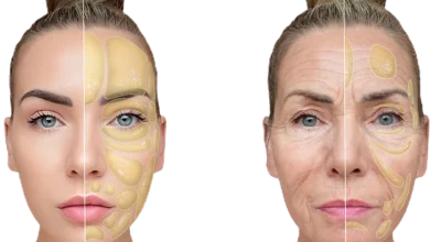 dermal fillers Orange CA