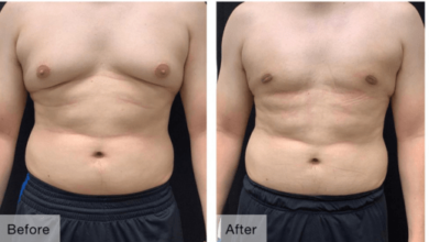 Gynecomastia Surgery in Bangalore